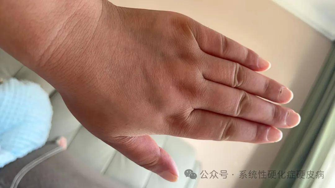 硬皮病最新治療，突破與挑戰(zhàn)并存，硬皮病最新治療，突破與挑戰(zhàn)同步前行