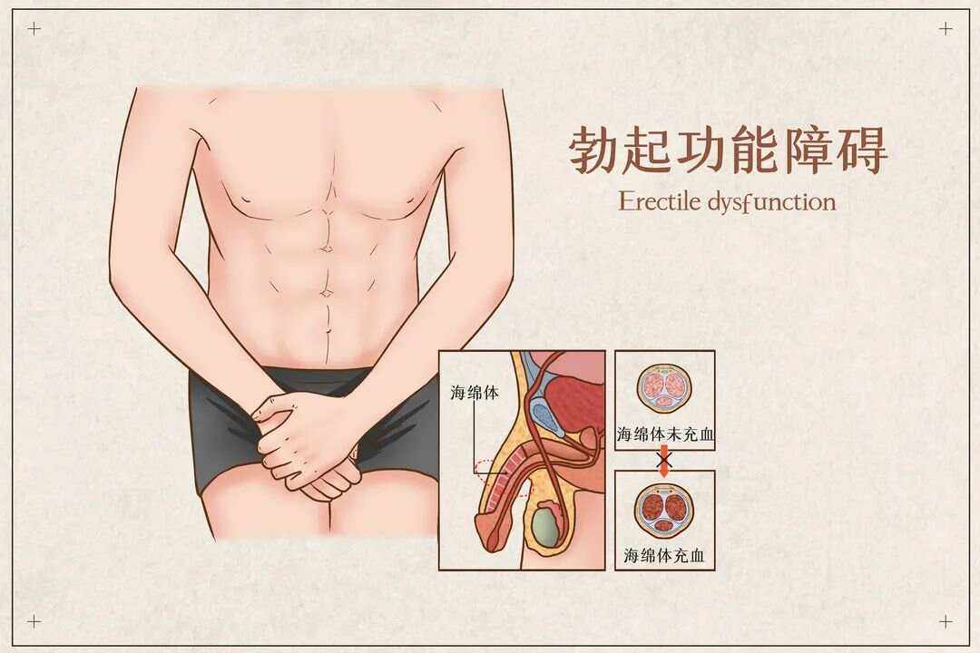 陽痿能自動恢復嗎，解析原因與探討可能性，陽痿能否自動恢復，原因解析與可能性探討
