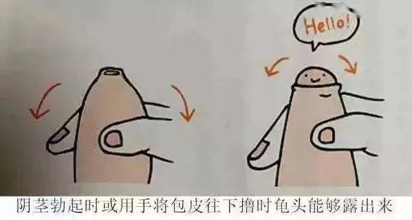 割包皮后需要注意的事項及用嘴巴是否可行，割包皮后注意事項詳解，口腔操作不可行，護理要點全解析