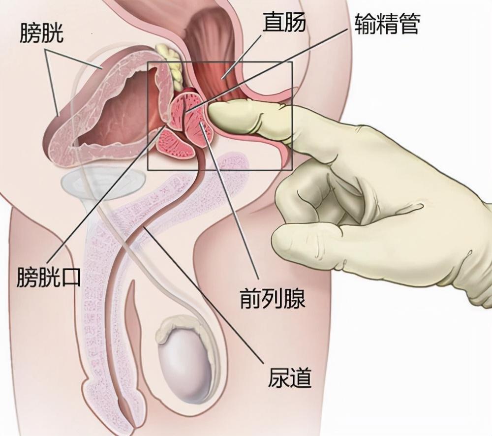 前列腺炎，重新認(rèn)識(shí)男性健康的誤區(qū)，重新認(rèn)識(shí)男性健康誤區(qū)，前列腺炎解析