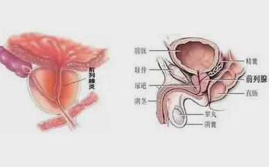 前列腺炎會伴隨一生嗎？解析前列腺炎的真相與防治策略，解析前列腺炎真相，防治策略與避免伴隨一生的風(fēng)險