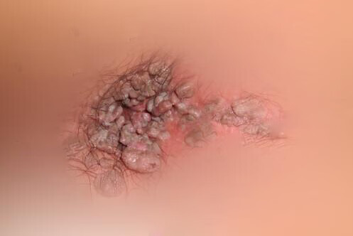 男性濕銳疣早期癥狀圖片及其相關解析，男性尖銳濕疣早期癥狀圖片及詳細解析
