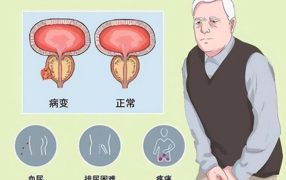 年輕人得了前列腺增大，理解、應(yīng)對(duì)與關(guān)注，年輕人前列腺增大，理解、應(yīng)對(duì)與關(guān)注的重要性