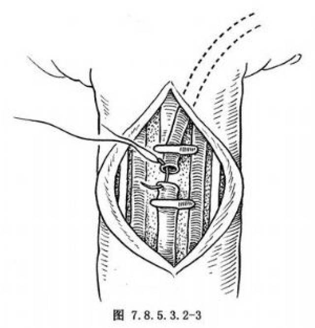 陽(yáng)瘺的最佳治療方法，中藥的獨(dú)到之處，陽(yáng)瘺最佳治療方法，中藥獨(dú)到之處的探索與實(shí)踐