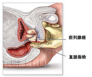 根治前列腺疾病的最佳中藥偏方，探尋古老智慧的新希望，古老智慧新希望，最佳中藥偏方根治前列腺疾病