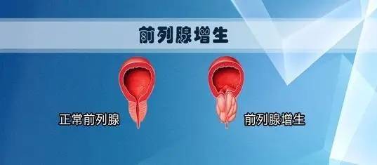 前列腺增生早期怎樣治療好，理解、管理與優(yōu)化，前列腺增生早期治療策略，理解、管理與優(yōu)化之道