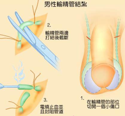 為什么醫(yī)院不提倡男性結(jié)扎，探究背后的原因與考量，探究醫(yī)院不提倡男性結(jié)扎的背后原因與考量
