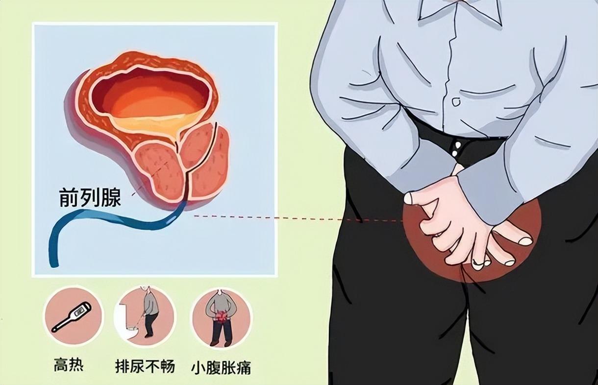 中藥治療前列腺炎的配方研究與應用，中藥治療前列腺炎的配方研究與實踐