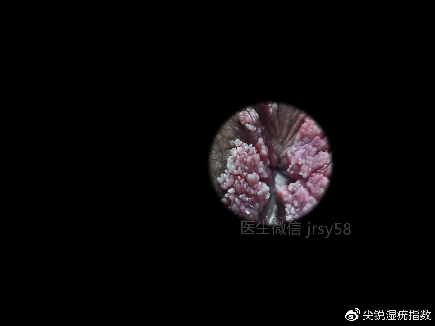 濕銳尖疣的確診方法，了解、預(yù)防與應(yīng)對，濕銳尖疣的確診方法，了解、預(yù)防與應(yīng)對策略
