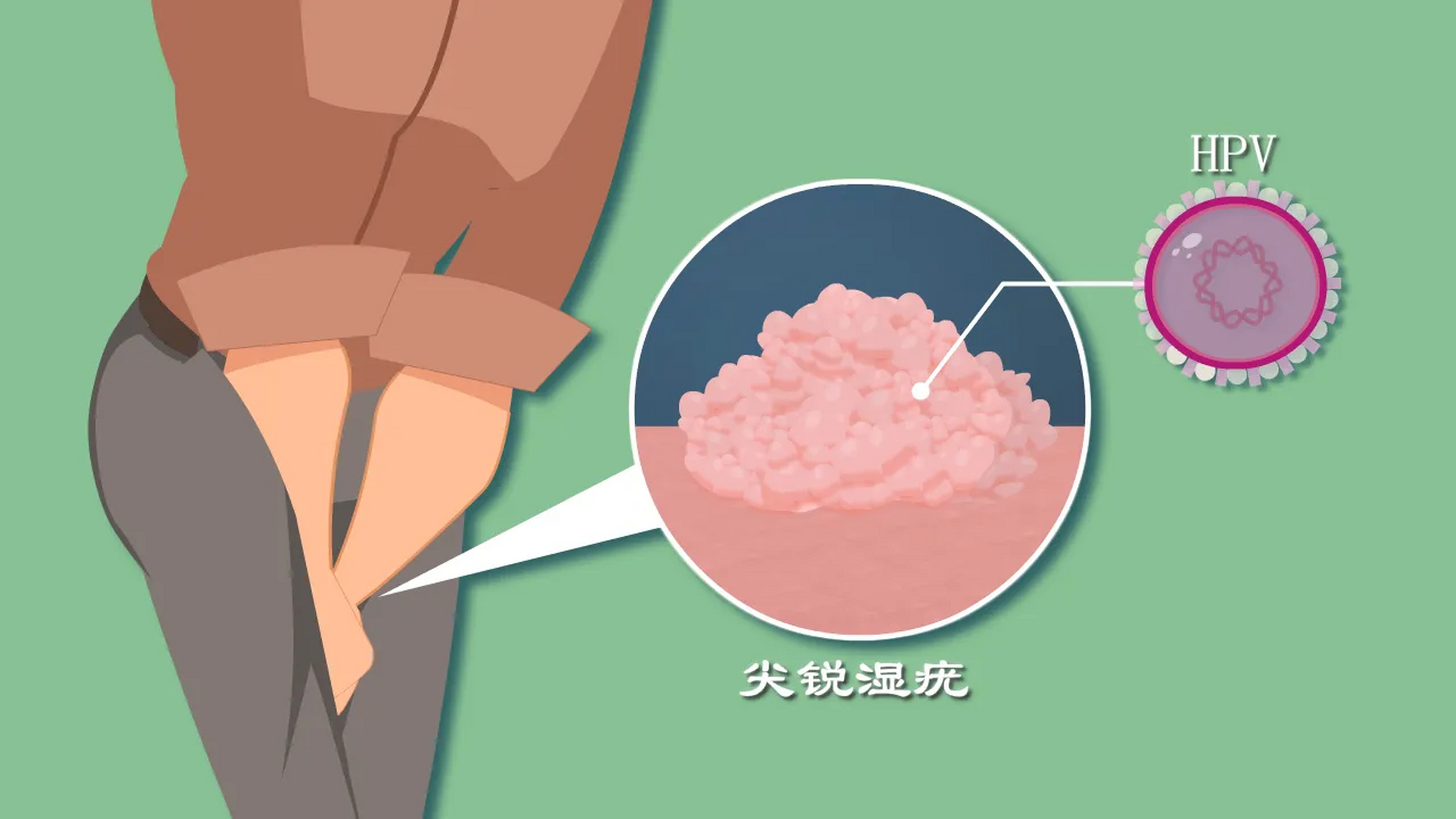 濕銳尖疣潛伏期，了解、預(yù)防與應(yīng)對(duì)，濕銳尖疣潛伏期，了解、預(yù)防與應(yīng)對(duì)策略