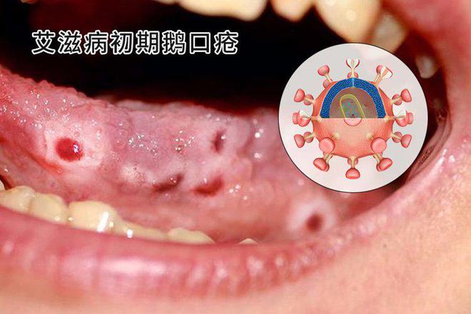 尖銳疣體，不處理疣體，能否轉(zhuǎn)陰？深度解析，尖銳疣體不處理疣體能否轉(zhuǎn)陰，深度解析與探討