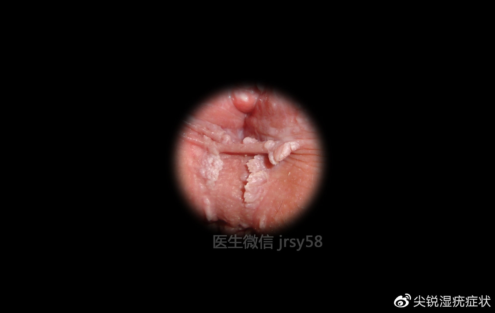 女性尖銳濕尤圖可以治愈嗎？解答你的疑惑，女性尖銳濕疣能否治愈？解答你的疑惑與疑慮