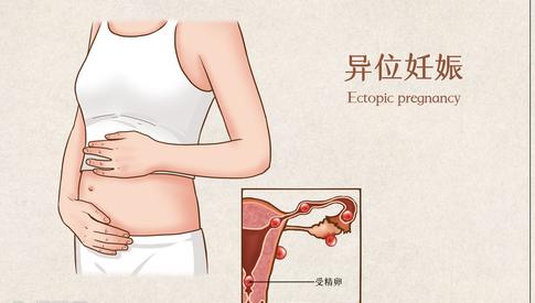征兵過(guò)程中發(fā)現(xiàn)盆腔積液會(huì)有影響嗎？解讀相關(guān)問(wèn)題及其應(yīng)對(duì)策略，征兵過(guò)程中盆腔積液的影響解讀與應(yīng)對(duì)策略
