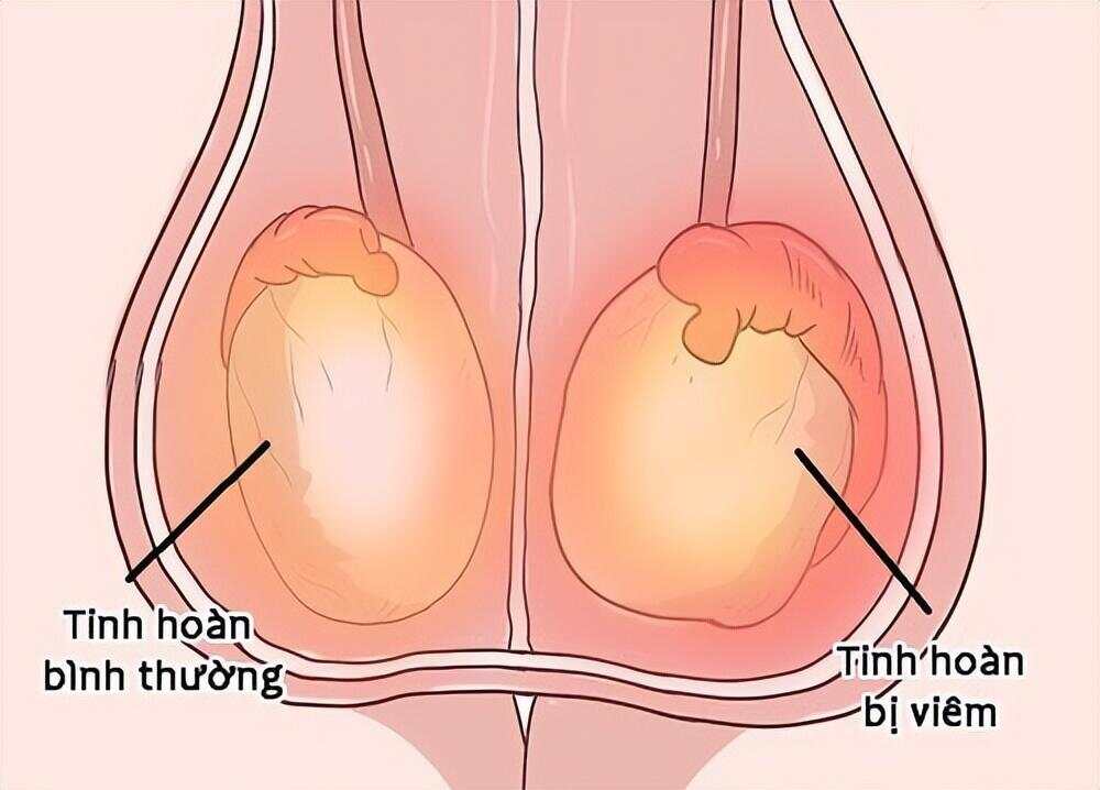 睪丸右邊疼左邊不疼的原因及解析，右側睪丸疼痛解析，原因與解析