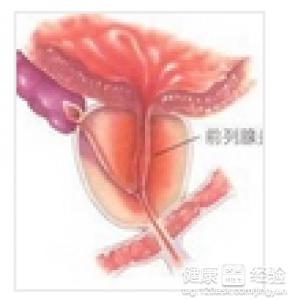 急性前列腺炎的癥狀與治療策略，急性前列腺炎的癥狀及治療策略概述