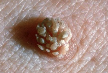 HPV，揭示一種常見病癥的真相，HPV，揭開常見病癥的神秘面紗