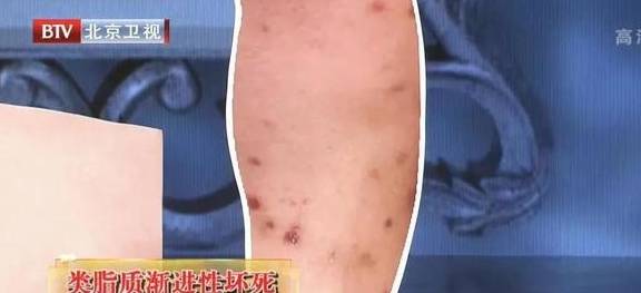 千萬別把絲狀疣想象得太嚴重，絲狀疣，不必過度擔憂