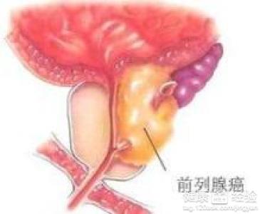 正規(guī)治療前列腺的方法，探索最佳治療方案，探索正規(guī)前列腺治療方法，最佳治療方案的全面解析