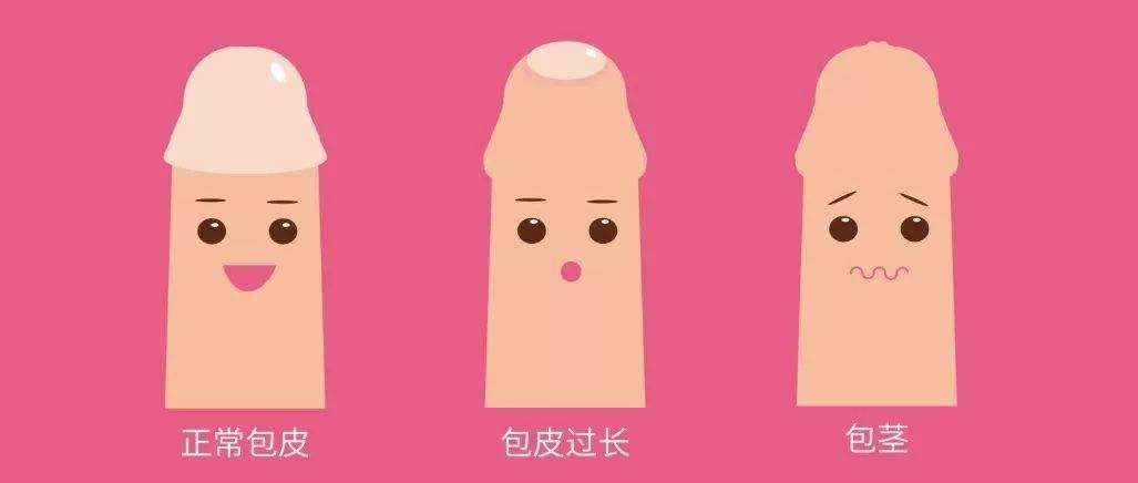 割完包莖一個星期圖片，恢復(fù)過程與注意事項(xiàng)，割完包莖一周恢復(fù)情況及注意事項(xiàng)，圖片詳解恢復(fù)過程與注意事項(xiàng)