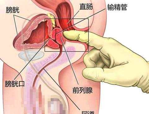 自己可以進(jìn)行前列腺按摩嗎？關(guān)于這個問題的探討與解答，我們需要從多個角度進(jìn)行深入的分析。本文將圍繞這一主題，從前列腺按摩的定義、應(yīng)用場景，到實際操作中的注意事項等方面進(jìn)行闡述。，前列腺按摩，自我操作的探討與注意事項