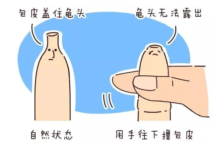 假性包皮過(guò)長(zhǎng)需要割嗎？——深入了解與科學(xué)決策，假性包皮過(guò)長(zhǎng)是否需要割？全面解析與明智決策