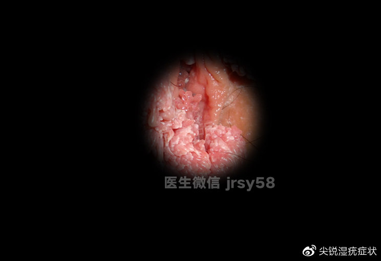 尖銳濕疹疣是否會(huì)自行消失？解析與應(yīng)對(duì)建議，尖銳濕疹疣是否會(huì)自行消退？解析、應(yīng)對(duì)與建議