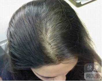 腎虛脫發(fā)癥狀，揭示背后的真相與應(yīng)對之道，腎虛脫發(fā)癥狀揭秘，真相與應(yīng)對之策
