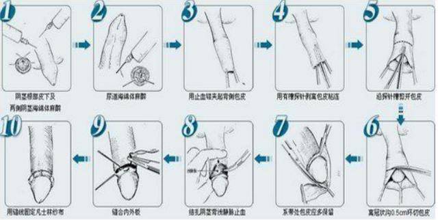 大人環(huán)切手術(shù)后的恢復(fù)圖及其相關(guān)解析，大人環(huán)切手術(shù)后的恢復(fù)圖詳解與解析